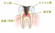 虫歯ができてしまったら