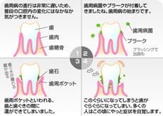 歯周病とは