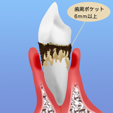 歯周ポケット6mm以上