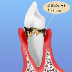 歯周ポケット4～7mm