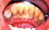 歯周病の治療（治療前）