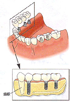 インプラント